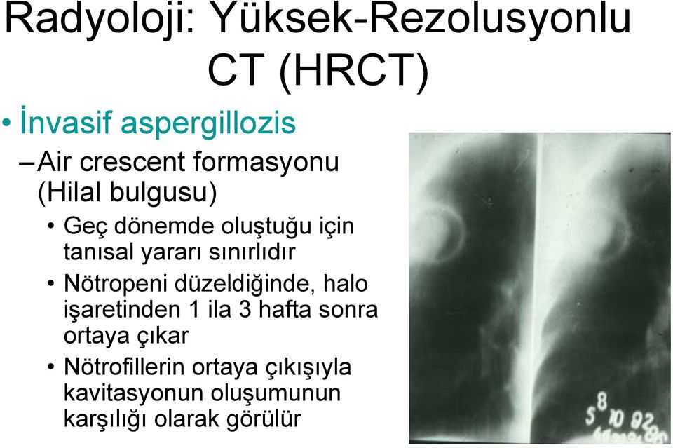 halo işaretinden 1 ila 3 hafta sonra ortaya çıkar Nötrofillerin ortaya çıkışıyla