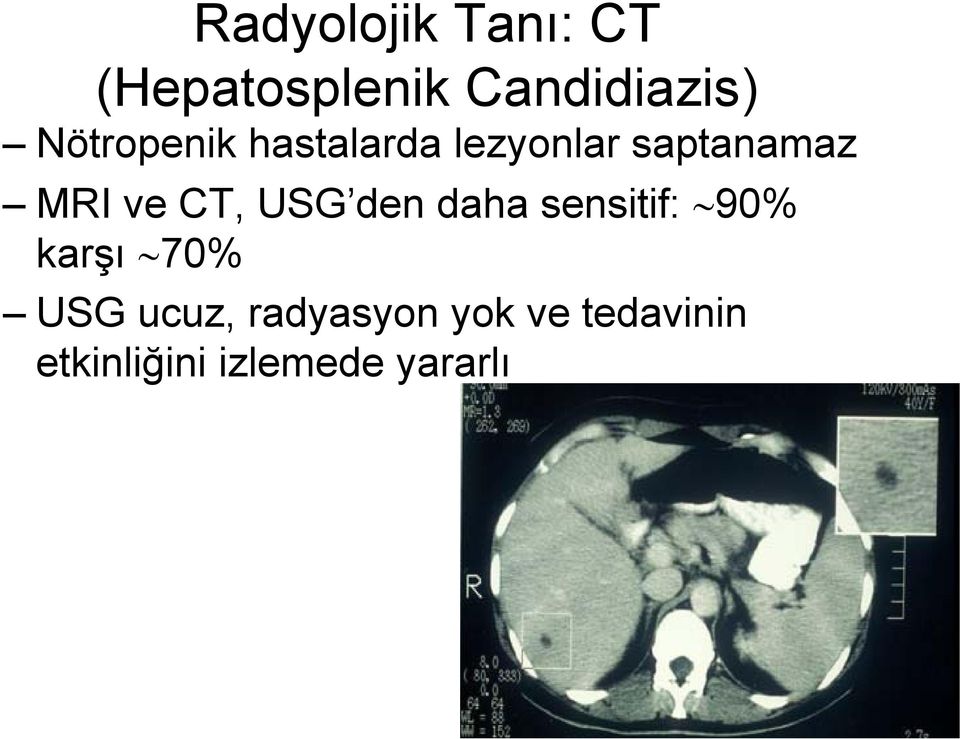 CT, USG den daha sensitif: 90% karşı 70% USG ucuz,