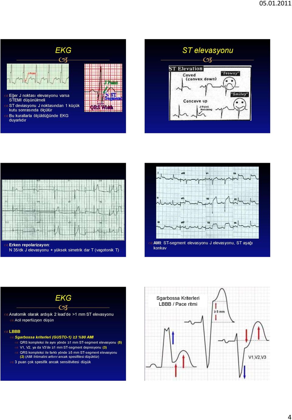 Acil reperfüzyon düşün EKG Sgarbossa Kriterleri LBBB / Pace ritmi LBBB Sgarbossa kriterleri (GUSTO-1) 3 %90 AMI QRS kompleksi ile aynı yönde 1 mm ST-segment elevasyonu (5) V1, V2, ya da