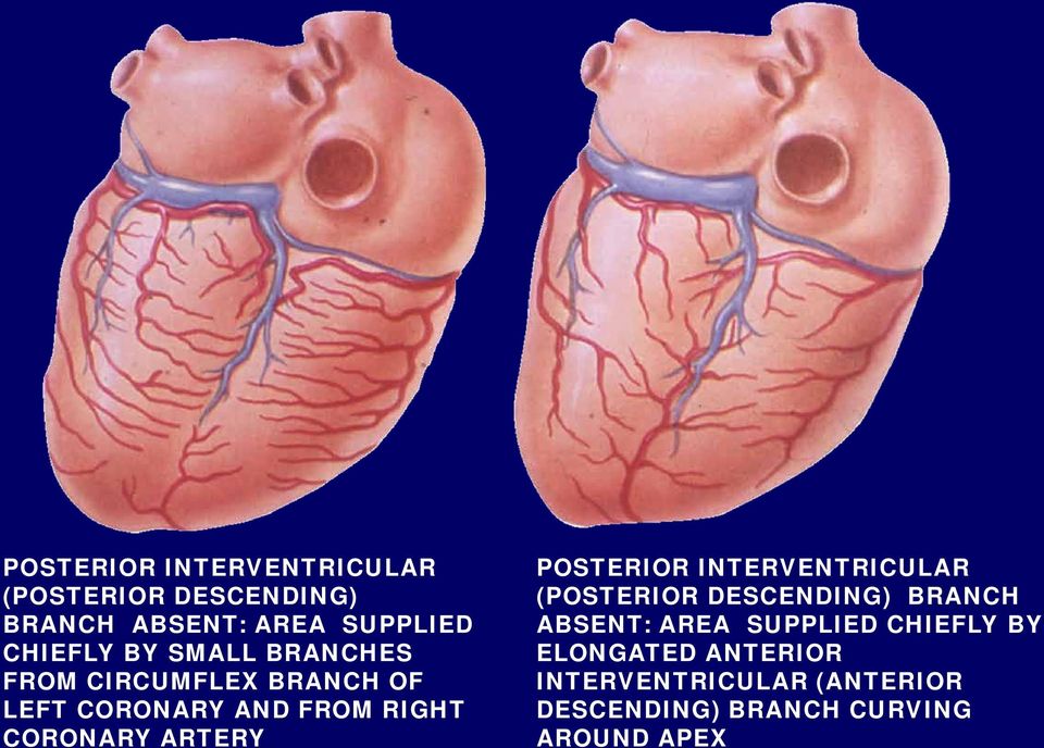 ARTERY  BY ELONGATED ANTERIOR INTERVENTRICULAR (ANTERIOR DESCENDING) BRANCH CURVING