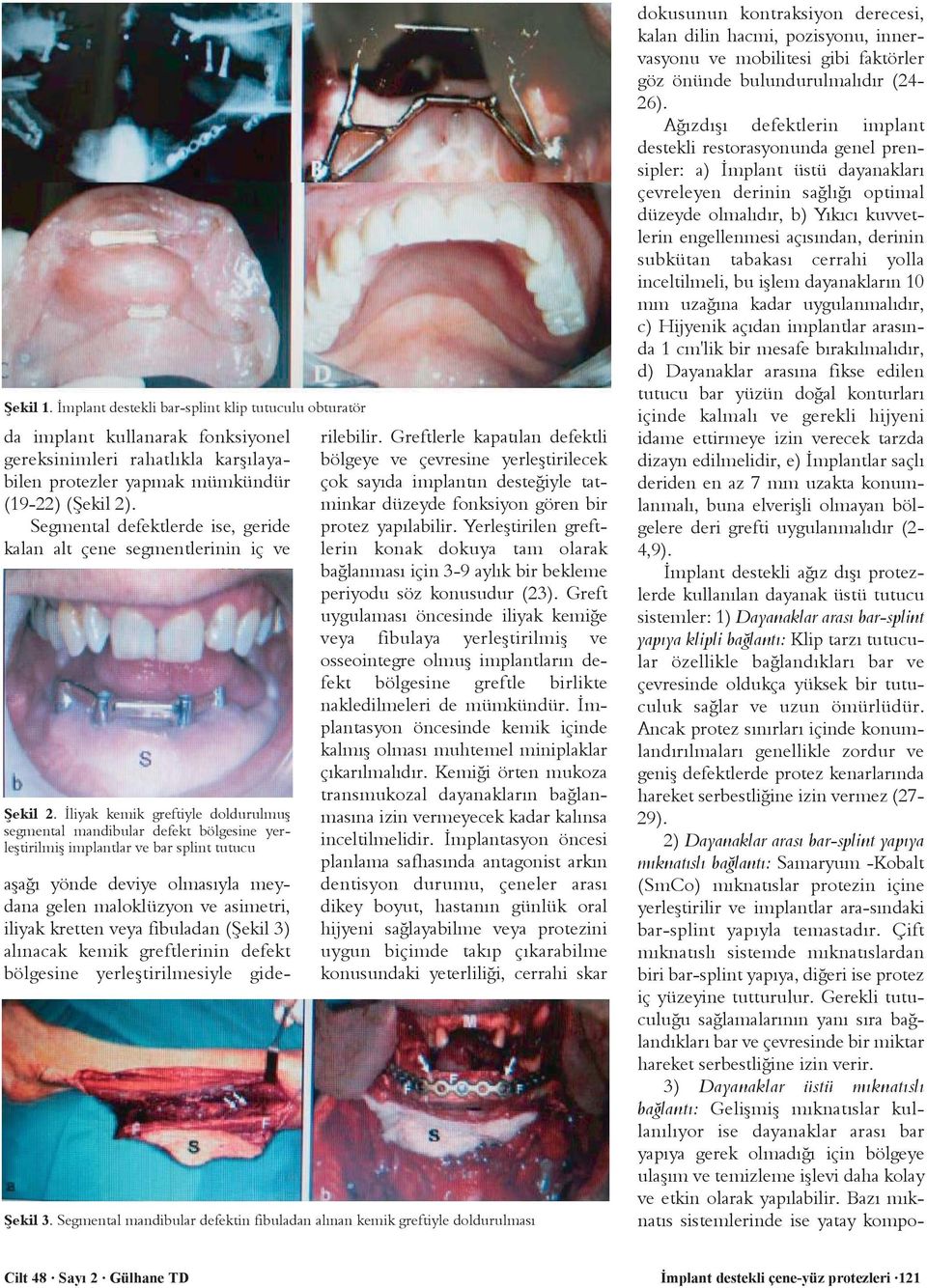 Ýliyak kemik greftiyle doldurulmuþ segmental mandibular defekt bölgesine yerleþtirilmiþ implantlar ve bar splint tutucu aþaðý yönde deviye olmasýyla meydana gelen maloklüzyon ve asimetri, iliyak