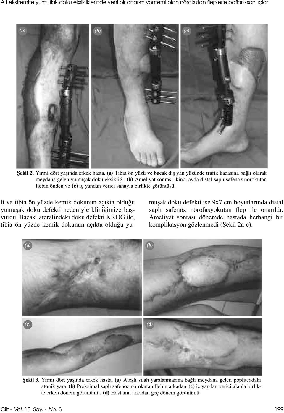 (b) Ameliyat sonras ikinci ayda distal sapl safenöz nörokutan flebin önden ve (c) iç yandan verici sahayla birlikte görüntüsü.