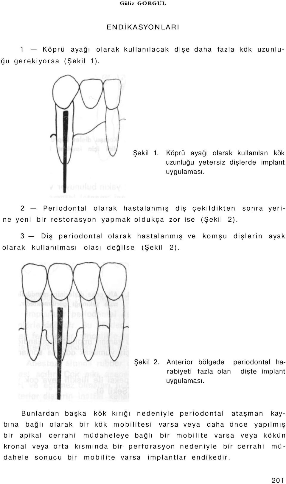 3 Diş periodontal olarak hastalanmış ve komşu dişlerin ayak olarak kullanılması olası değilse (Şekil 2). Şekil 2. Anterior bölgede periodontal harabiyeti fazla olan dişte implant uygulaması.
