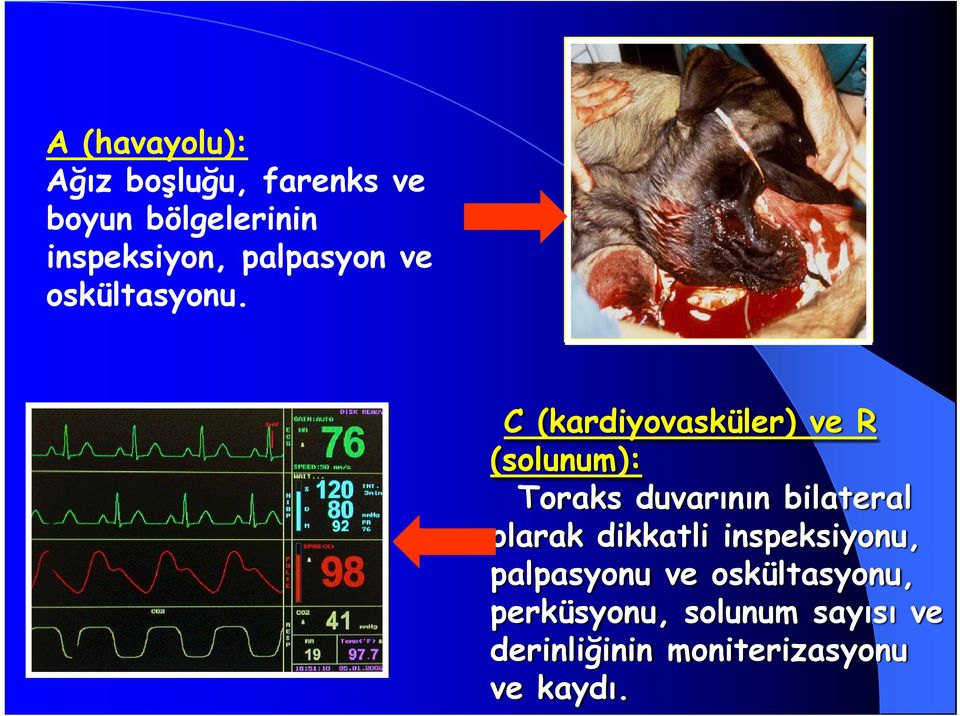 C (kardiyovasküler) ve R (solunum): Toraks duvarının bilateral olarak