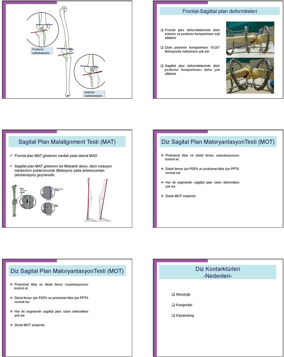 plan MAT gösteren medial yada lateral MAD Sagittal plan MAT gösteren ise Mekanik aksın, dizin rotasyon merkezinin posteriorunda (fleksiyon) yada anteriorundan (ekstansiyon) geçmesidir.