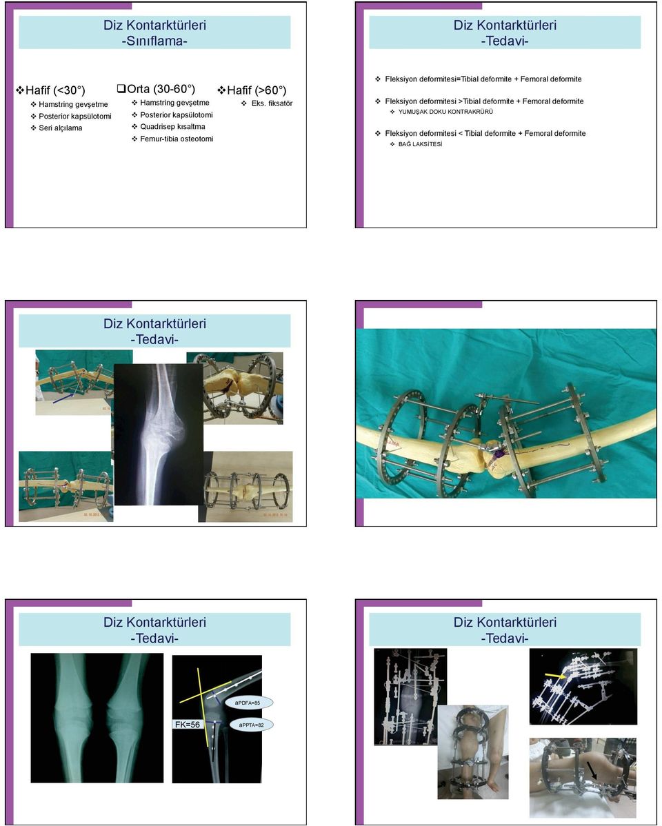 fiksatör Fleksiyon deformitesi=tibial deformite + Femoral deformite Fleksiyon deformitesi >Tibial deformite + Femoral deformite