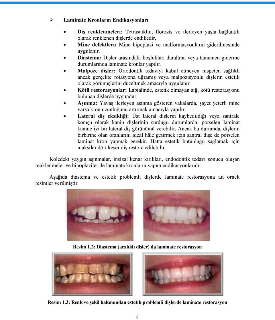 Malpoze diģler: Ortodontik tedaviyi kabul etmeyen nispeten sağlıklı ancak gerçekte rotasyona uğramıģ veya malpozisyonlu diģlerin estetik olarak görünüģlerini düzeltmek amacıyla uygulanır.