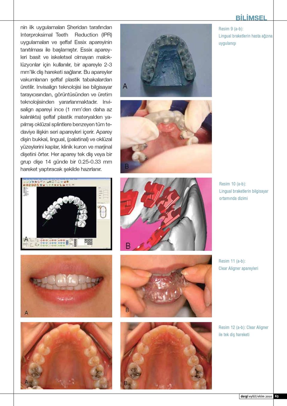 Invisalign teknolojisi ise bilgisayar tarayıcısından, görüntüsünden ve üretim teknolojisinden yararlanmaktadır.