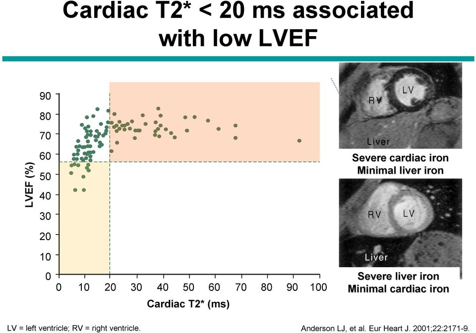 100 Cardiac T2* (ms) Severe liver iron Minimal cardiac iron LV = left