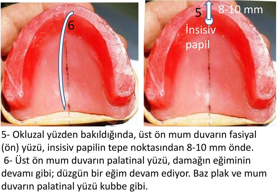 6 Üst ön mum duvarın palatinal yüzü, damağın eğiminin devamı gibi;