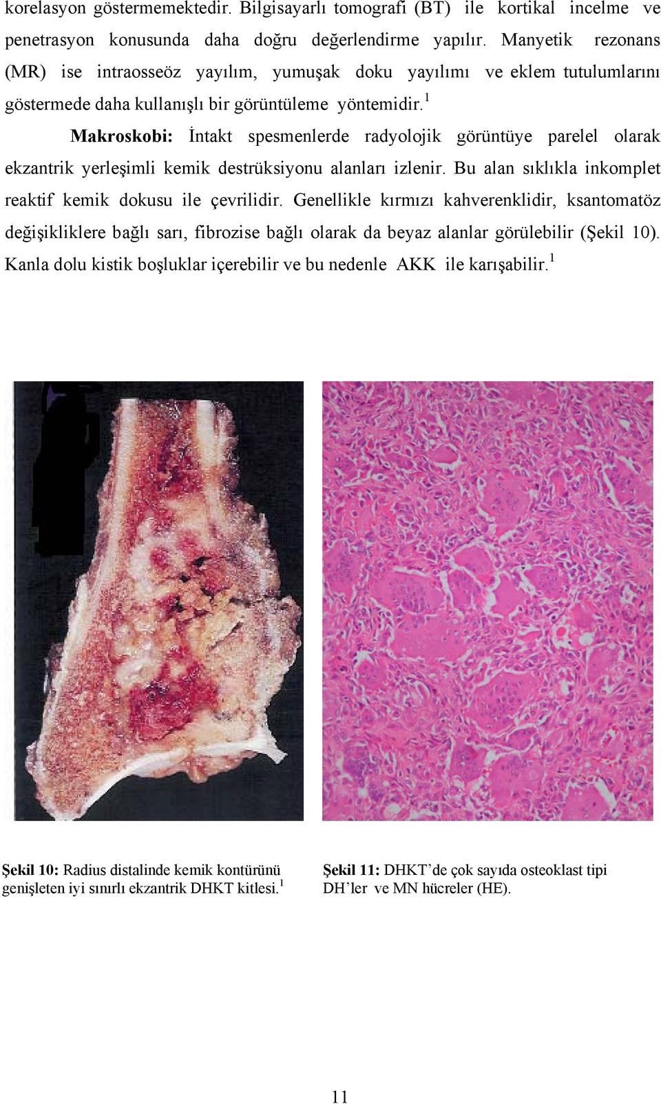 1 Makroskobi: İntakt spesmenlerde radyolojik görüntüye parelel olarak ekzantrik yerleşimli kemik destrüksiyonu alanları izlenir. Bu alan sıklıkla inkomplet reaktif kemik dokusu ile çevrilidir.