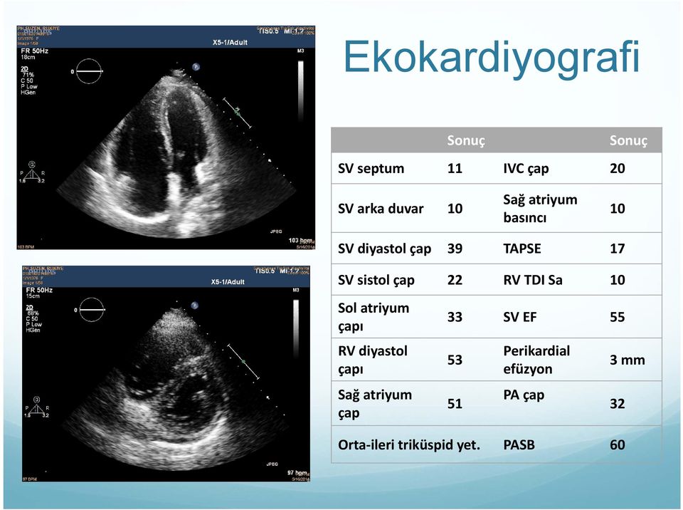 TDI Sa 10 Sol atriyum çapı RV diyastol çapı Sağ atriyum çap 33 SV EF 55