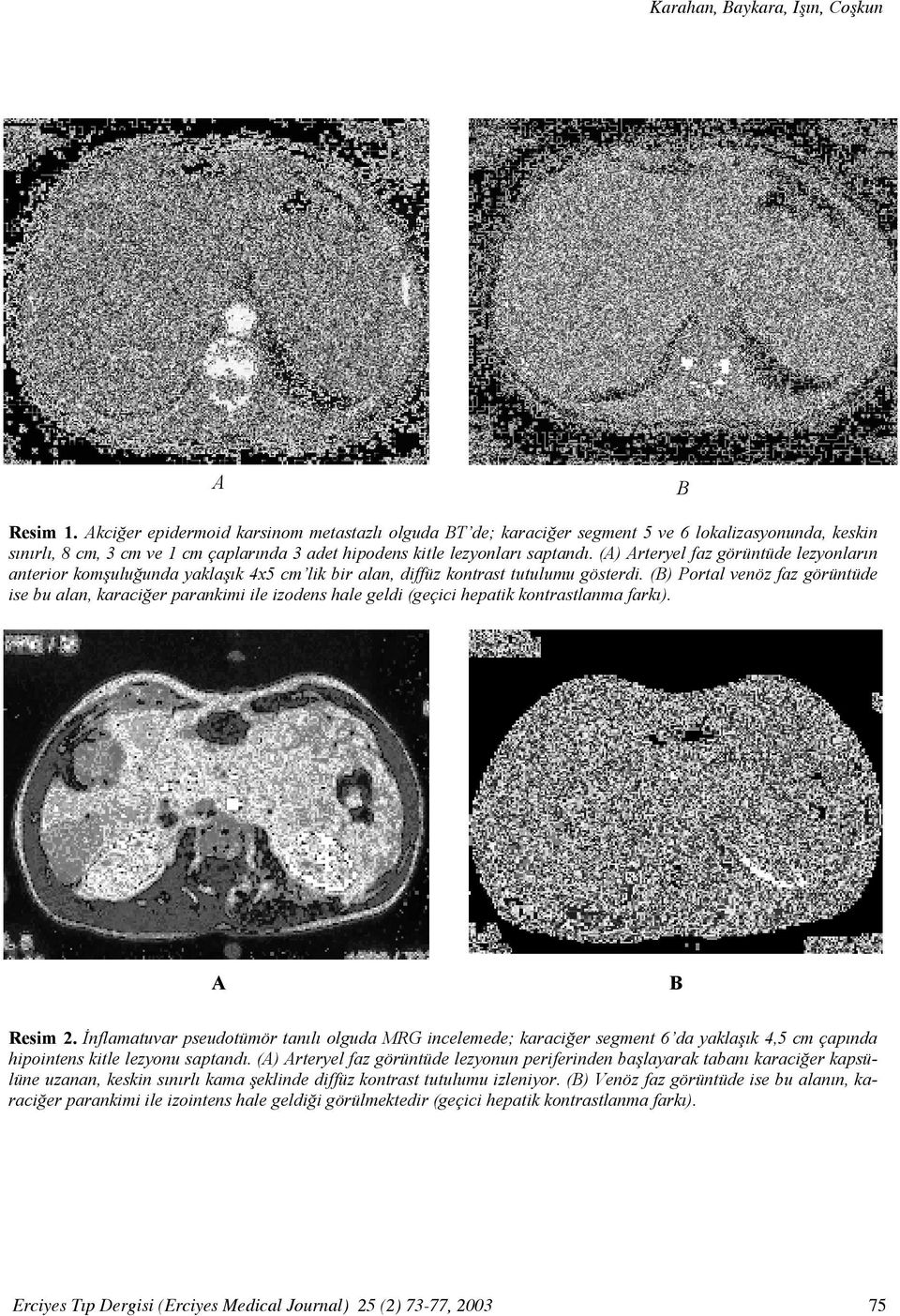 (A) Arteryel faz görüntüde lezyonların anterior komşuluğunda yaklaşık 4x5 cm lik bir alan, diffüz kontrast tutulumu gösterdi.