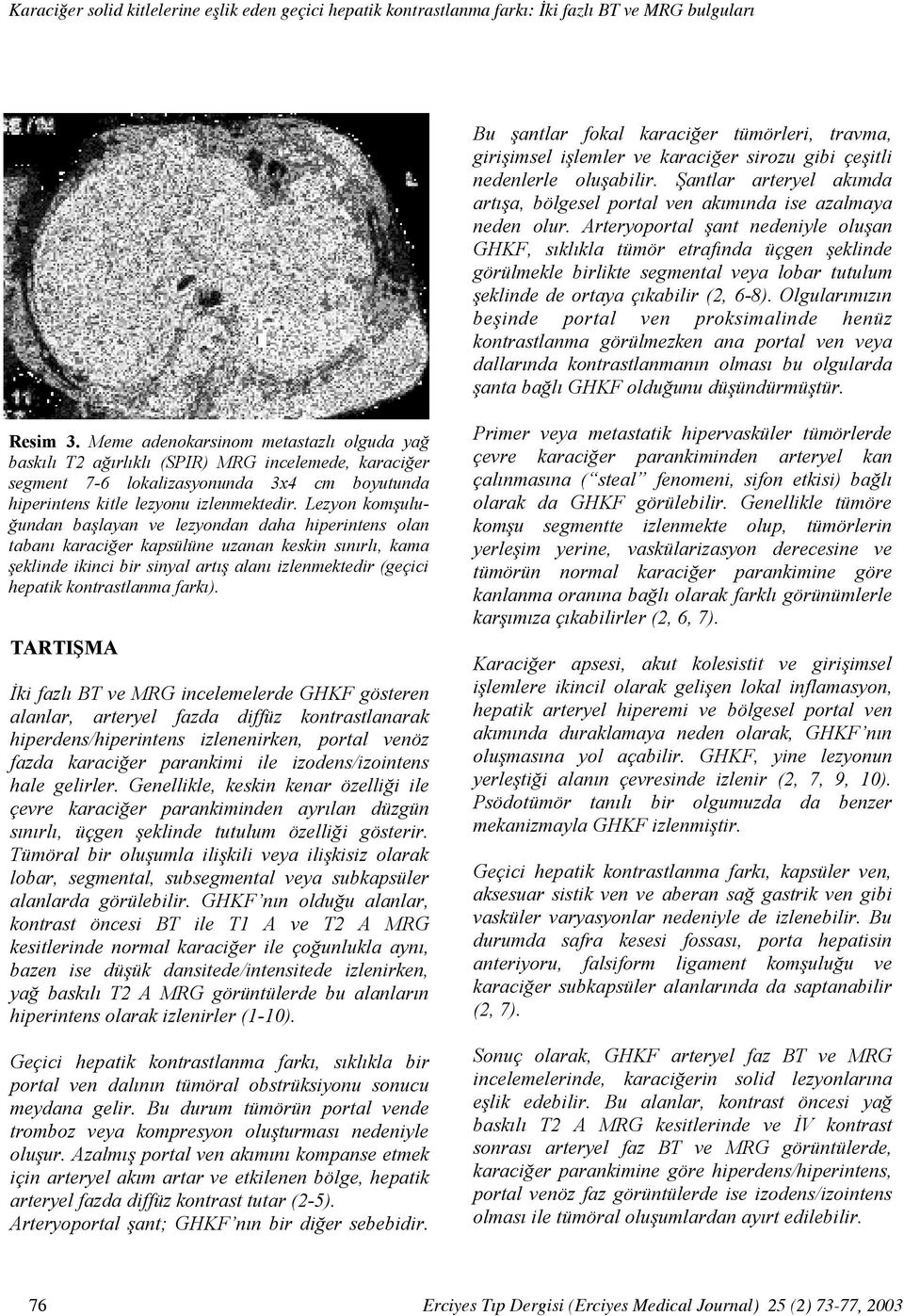 Arteryoportal şant nedeniyle oluşan GHKF, sıklıkla tümör etrafında üçgen şeklinde görülmekle birlikte segmental veya lobar tutulum şeklinde de ortaya çıkabilir (2, 6-8).