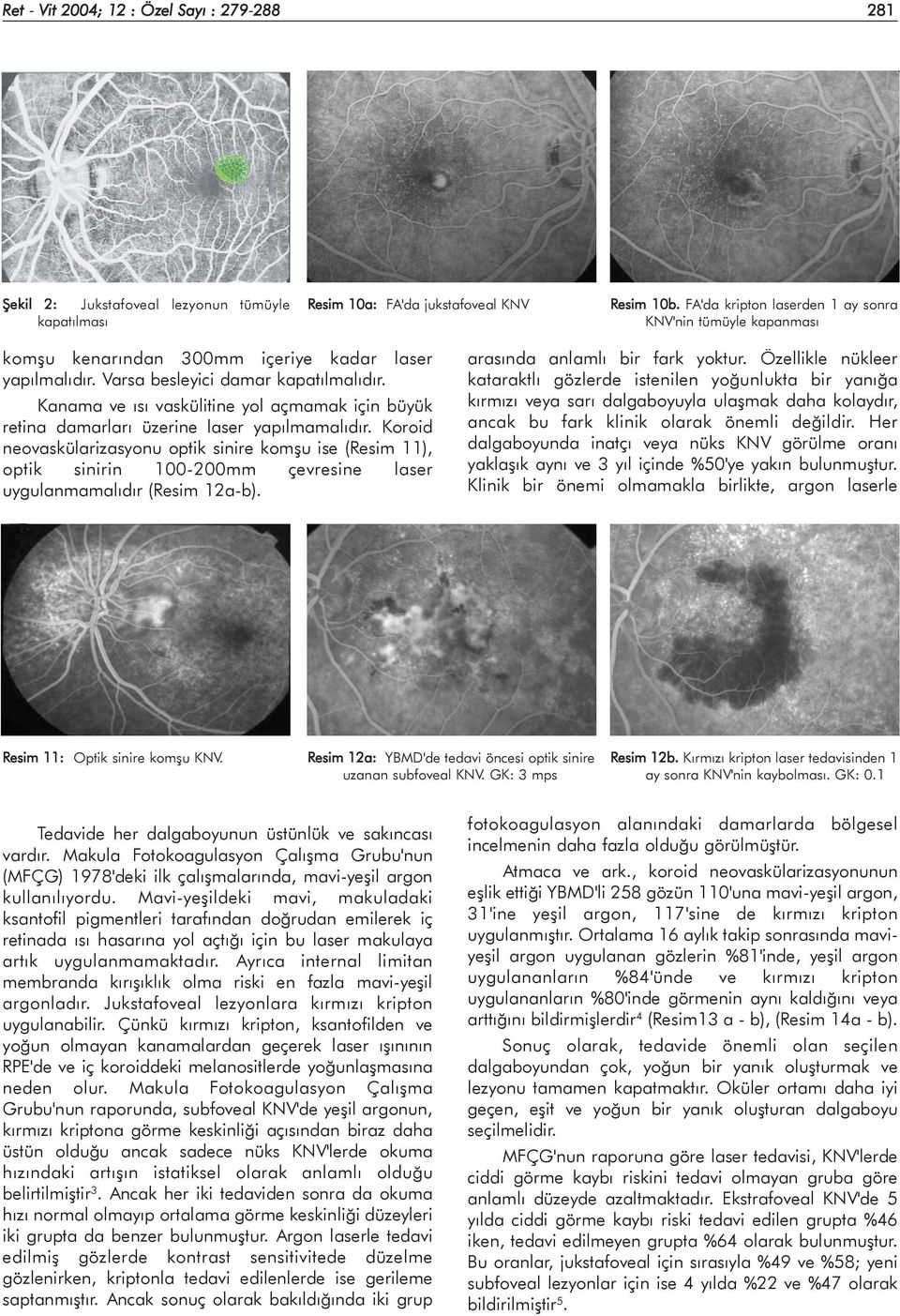 Kanama ve ýsý vaskülitine yol açmamak için büyük retina damarlarý üzerine laser yapýlmamalýdýr.