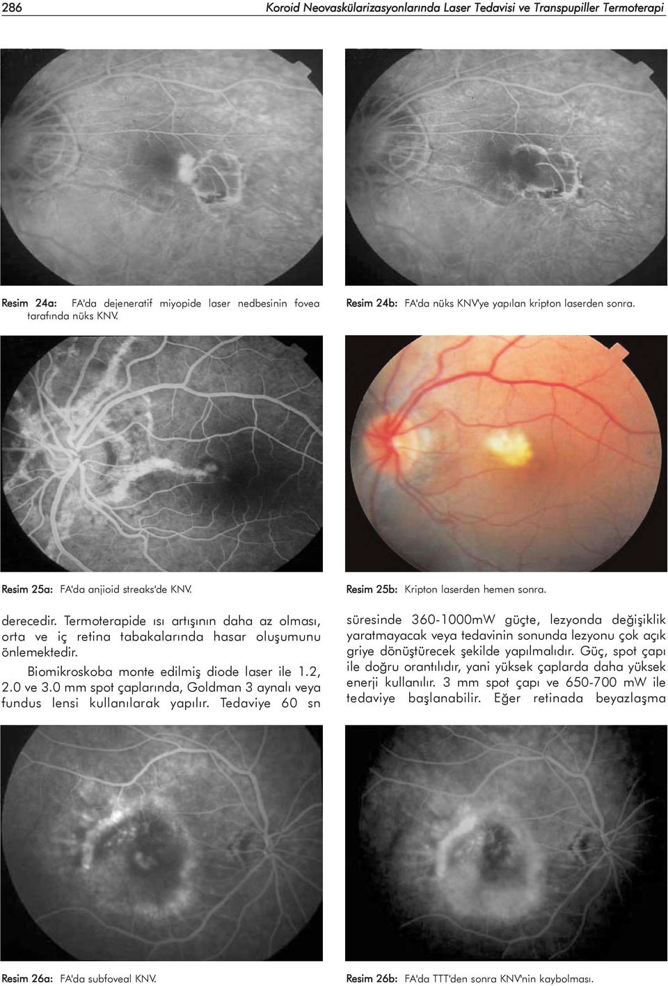 Termoterapide ýsý artýþýnýn daha az olmasý, orta ve iç retina tabakalarýnda hasar oluþumunu önlemektedir. Biomikroskoba monte edilmiþ diode laser ile 1.2, 2.0 ve 3.