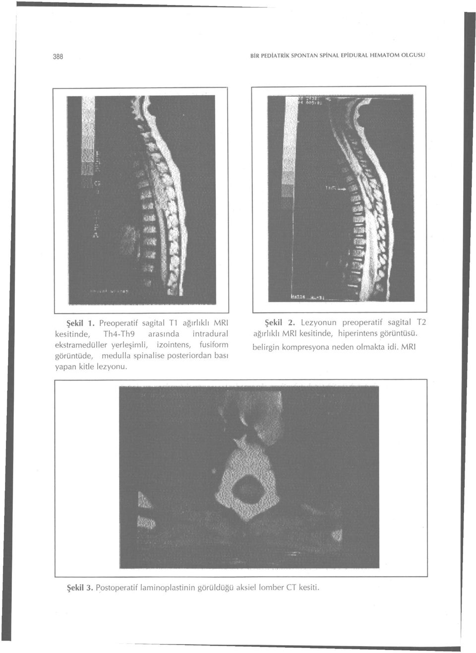 fusiform görüntüde, medulla spinalise posteriordan bası yapan kitle lezyonu. Şekil 2.