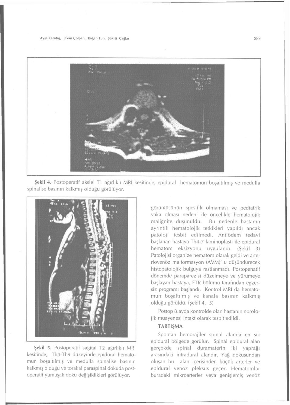 Bu nedenle hastanın ayrıntılı hematolojik tetkikleri yapıldı ancak patoloji tesbit edilmedi. Antiödem tedavi başlanan hastaya Th4-7 laminoplasti ile epidural hematom eksizyonu uygulandı.