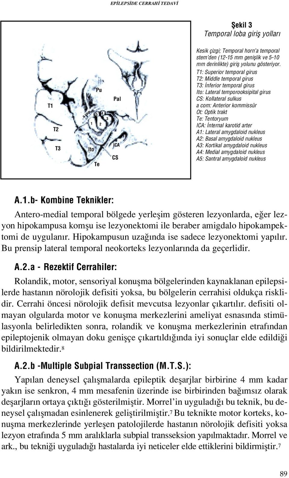 T1: Superior temporal girus T2: Middle temporal girus T3: nferior temporal girus Ito: Lateral temporooksipital girus CS: Kollateral sulkus a com: Anterior kommissür Ot: Optik trakt Te: Tentoryum ICA: