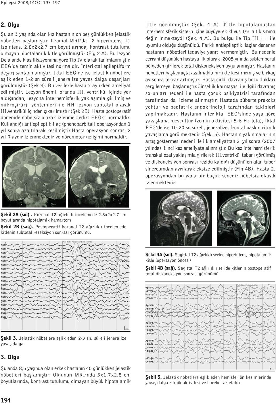 Ýnteriktal epileptiform deþarj saptanmamýþtýr. Ýktal EEG de ise jelastik nöbetlere eþlik eden 1-2 sn süreli jeneralize yavaþ dalga deþarjlarý görülmüþtür (Þek 3).