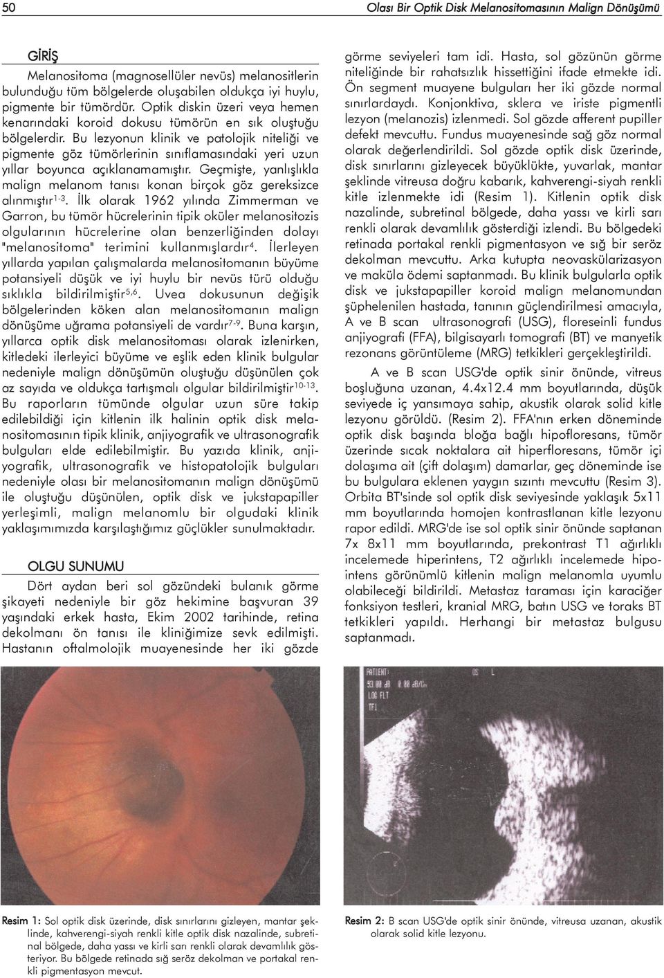 Bu lezyonun klinik ve patolojik niteliði ve pigmente göz tümörlerinin sýnýflamasýndaki yeri uzun yýllar boyunca açýklanamamýþtýr.