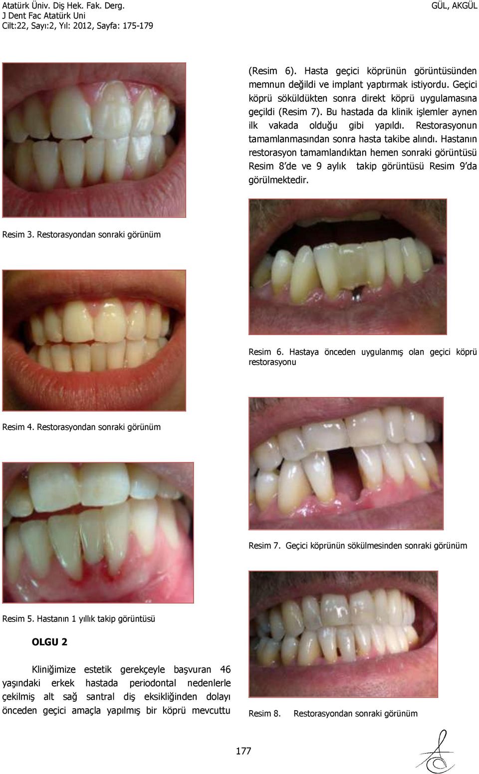 Hastanın restorasyon tamamlandıktan hemen sonraki görüntüsü Resim 8 de ve 9 aylık takip görüntüsü Resim 9 da görülmektedir. Resim 3. Restorasyondan sonraki görünüm Resim 6.