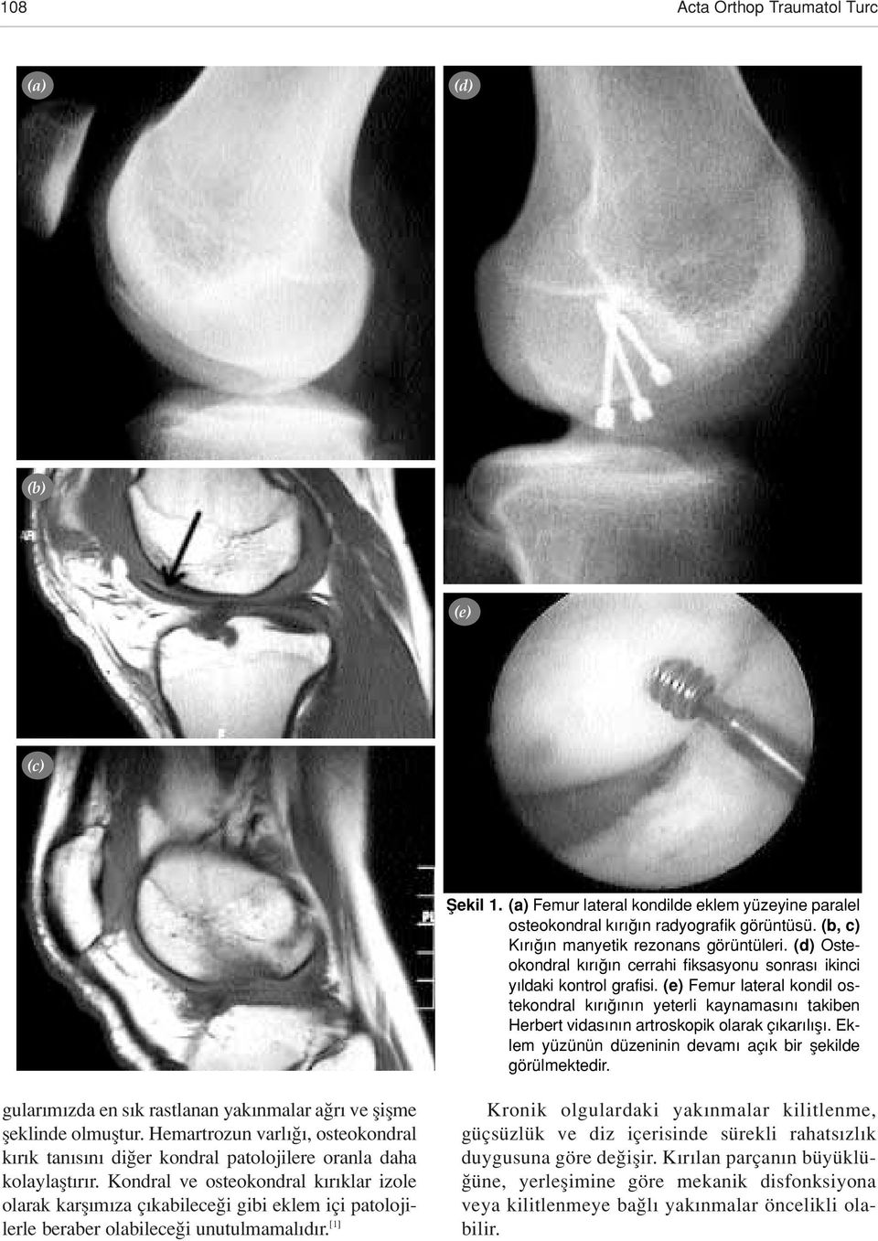 (e) Femur lateral kondil ostekondral k r n n yeterli kaynamas n takiben Herbert vidas n n artroskopik olarak ç kar l fl. Eklem yüzünün düzeninin devam aç k bir flekilde görülmektedir.