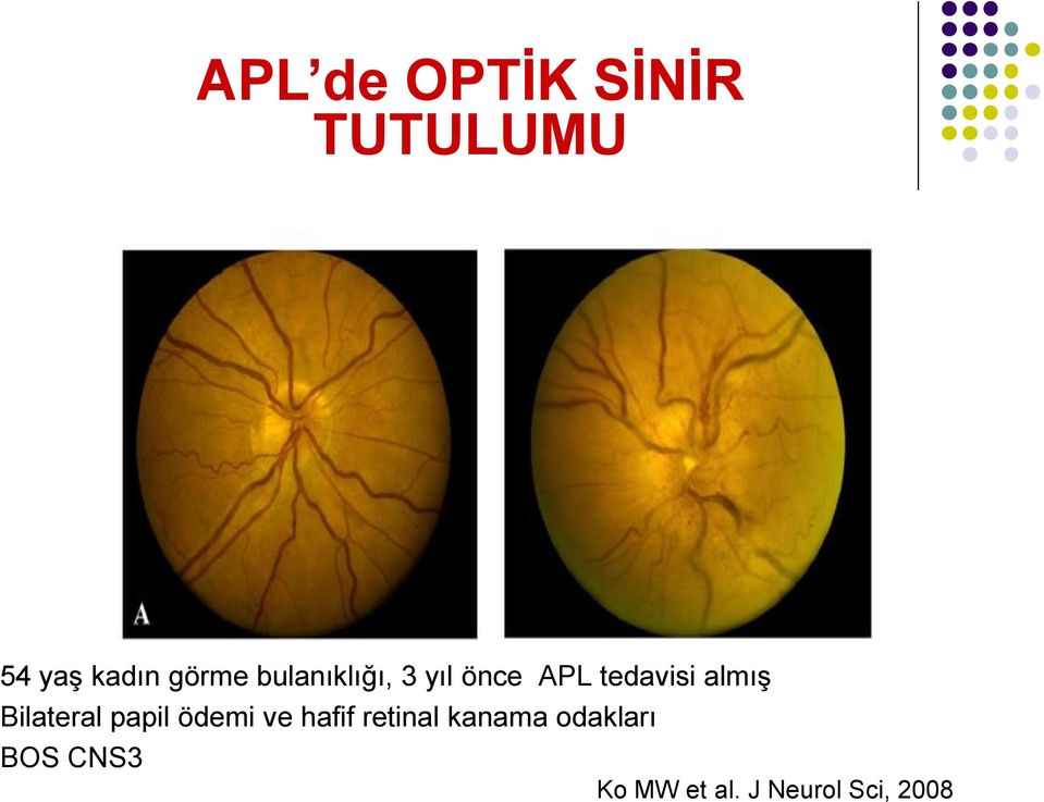 Bilateral papil ödemi ve hafif retinal kanama