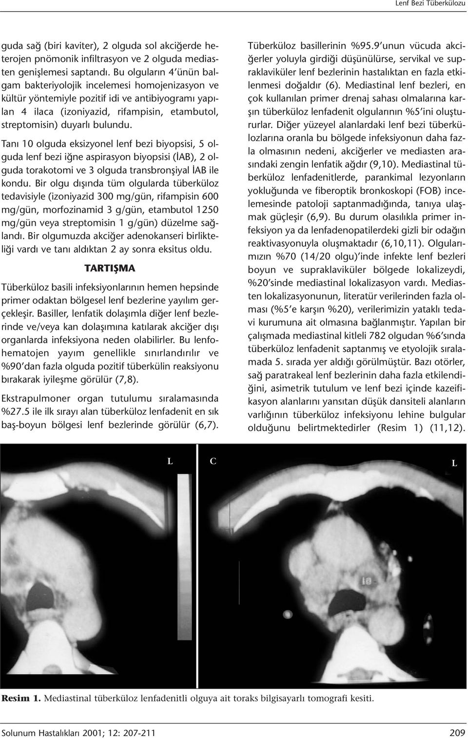 Tanı 10 olguda eksizyonel lenf bezi biyopsisi, 5 olguda lenf bezi iğne aspirasyon biyopsisi (İAB), 2 olguda torakotomi ve 3 olguda transbronşiyal İAB ile kondu.