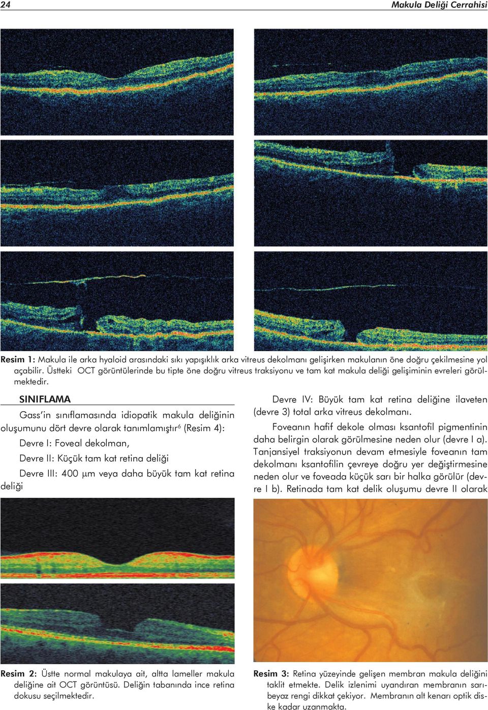 SINIFLAMA Gass in sınıflamasında idiopatik makula deliğinin oluşumunu dört devre olarak tanımlamıştır6 (Resim 4): Devre I: Foveal dekolman, Devre II: Küçük tam kat retina deliği Devre III: 400 μm
