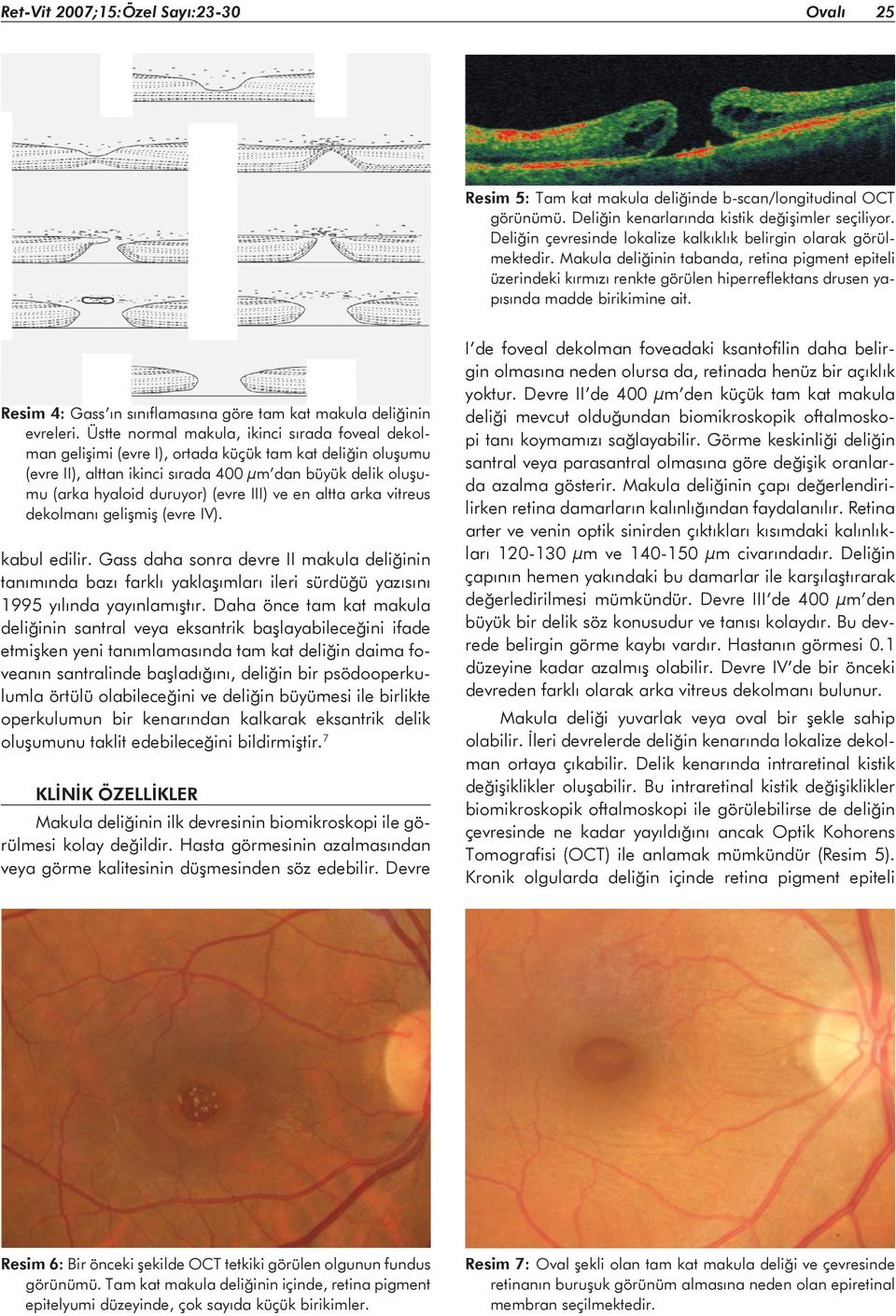 Makula deliğinin tabanda, retina pigment epiteli üzerindeki kırmızı renkte görülen hiperreflektans drusen yapısında madde birikimine ait.