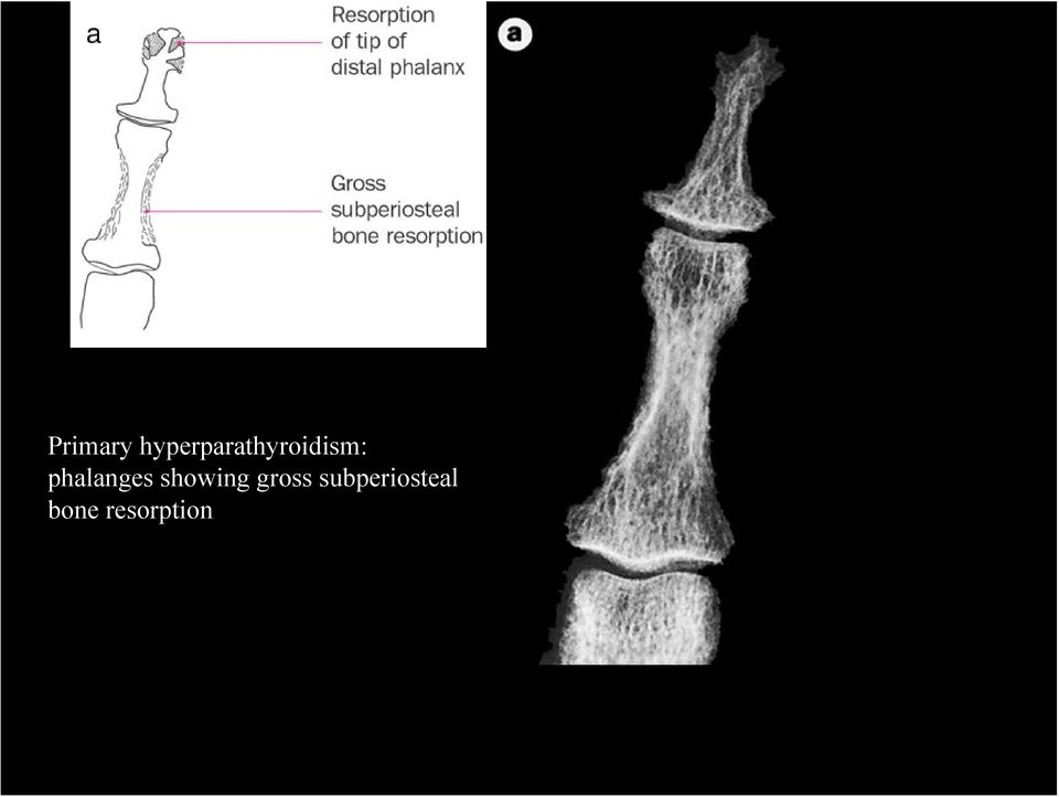 phalanges showing