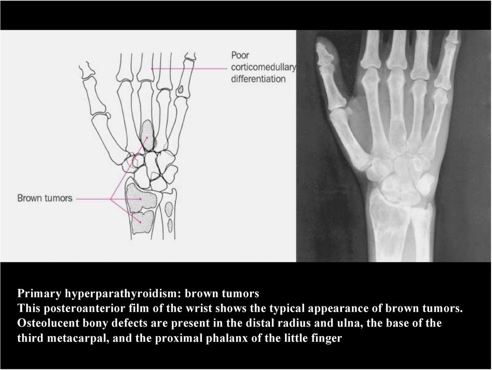 Osteolucent bony defects are present in the distal radius and ulna,