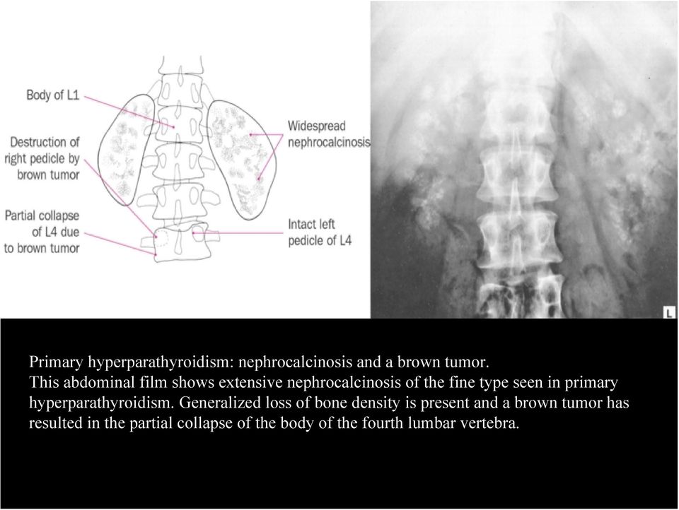 primary hyperparathyroidism.