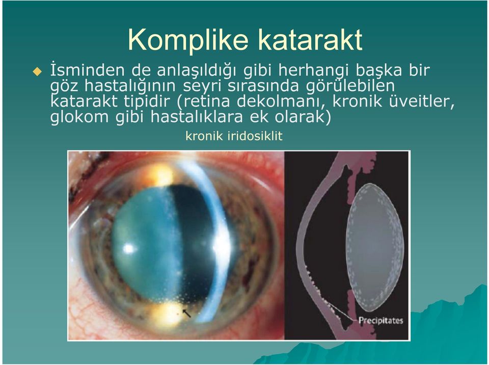görülebilen katarakt tipidir (retina dekolmanı, kronik