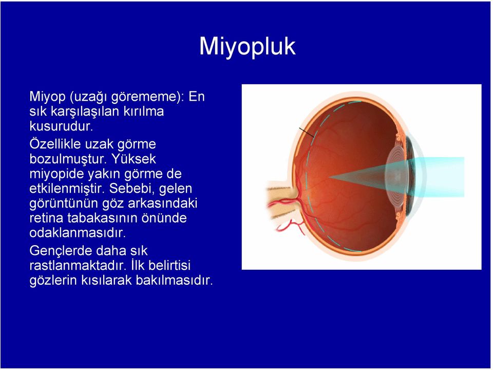 Sebebi, gelen görüntünün göz arkasındaki retina tabakasının önünde