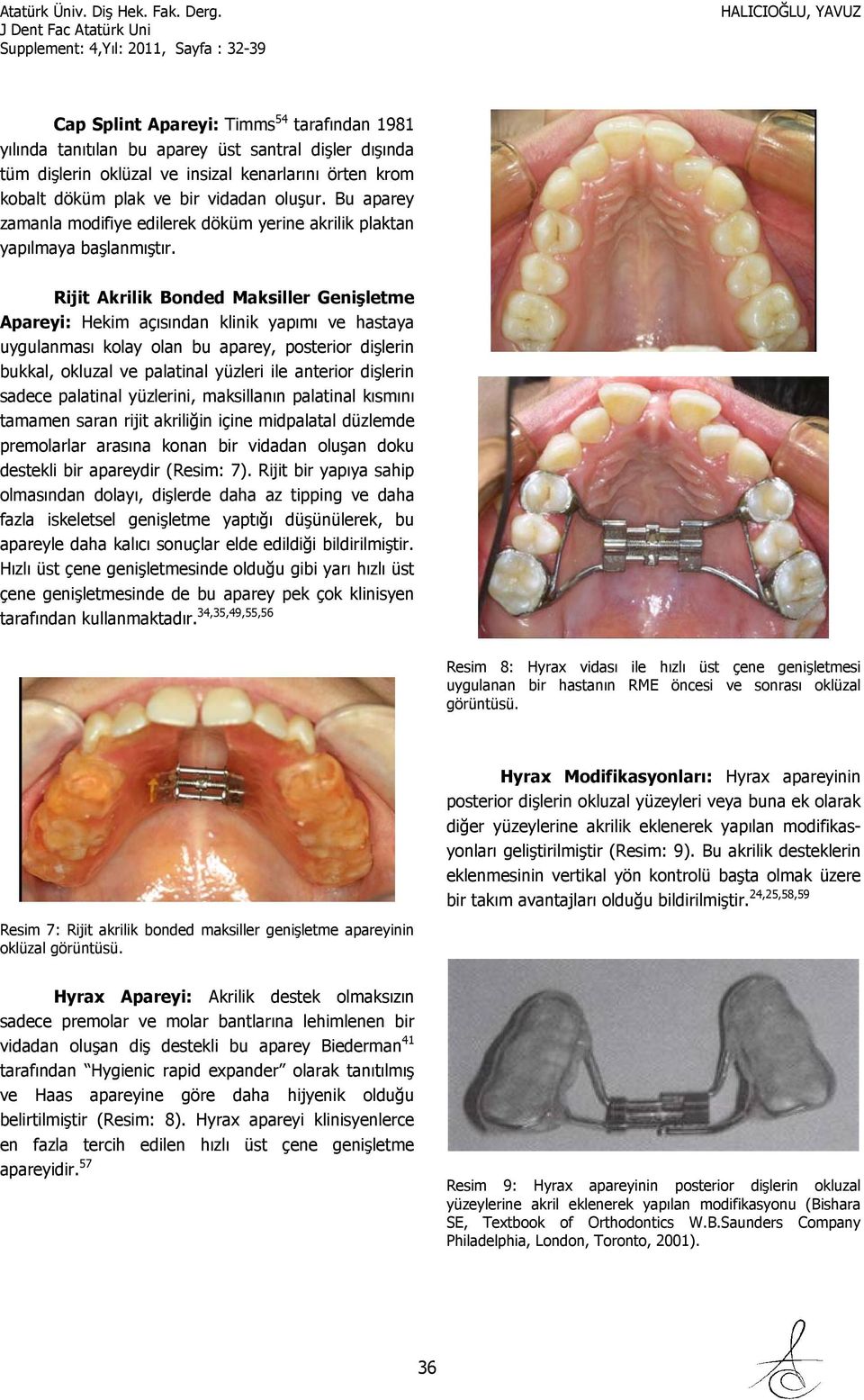 Rijit Akrilik Bonded Maksiller Genişletme Apareyi: Hekim açısından klinik yapımı ve hastaya uygulanması kolay olan bu aparey, posterior dişlerin bukkal, okluzal ve palatinal yüzleri ile anterior