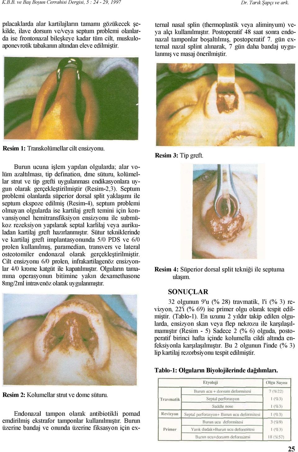 gün external nazal splint alınarak, 7 gün daha bandaj uygulanmış ve masaj önerilmiştir. Resim 1: Transkolümellar cilt ensizyonu.