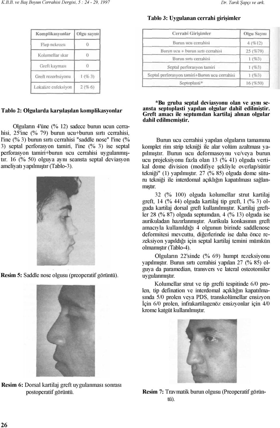 16 (% 50) olguya aynı seansta septal deviasyon ameliyatı yapılmıştır (Tablo-3). Resim 5: Saddle nose olgusu (preoperatif görüntü).