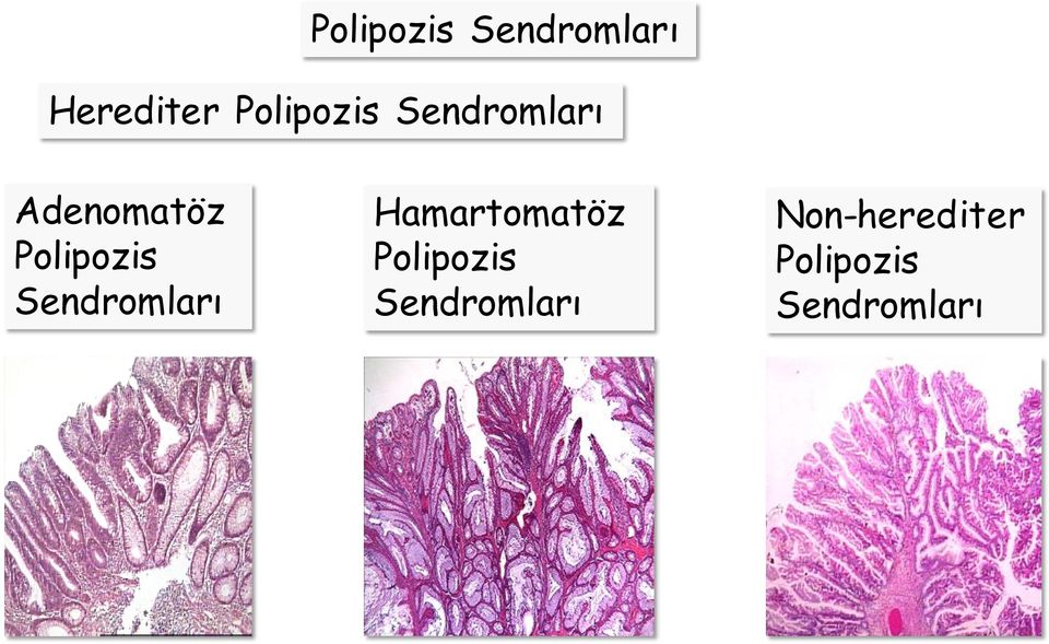 Polipozis Sendromları Hamartomatöz