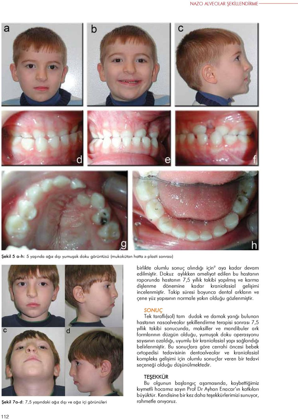 Takip süresi boyunca dental arkların ve çene yüz yapısının normale yakın olduğu gözlenmiştir.