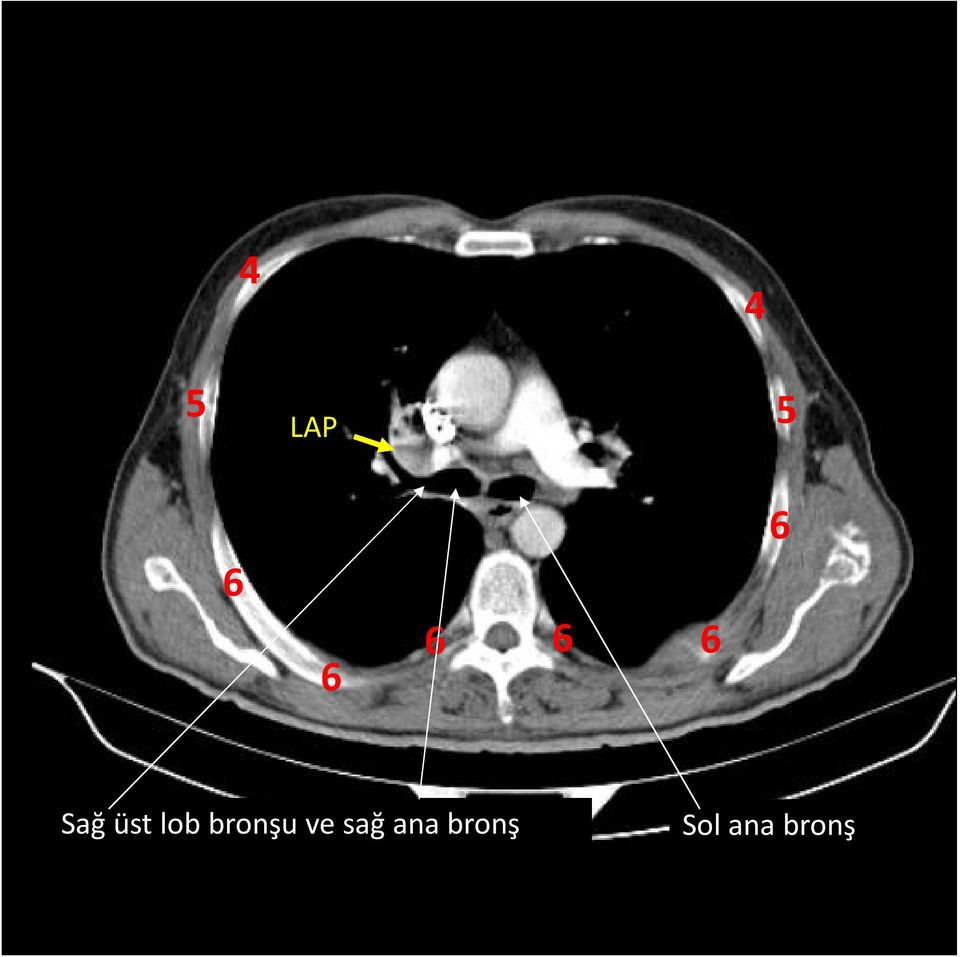 bronşu ve sağ ana