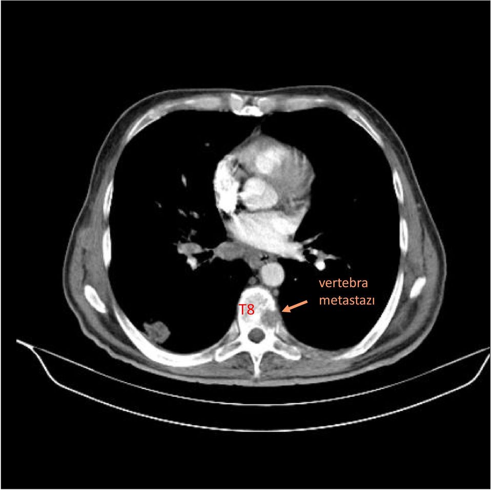 metastazı