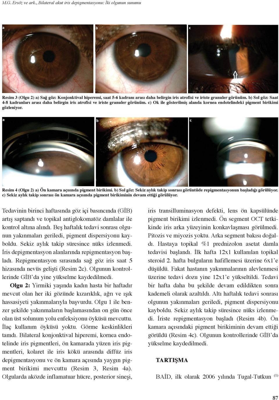 b) Sol göz: Saat 4-8 kadranları arası daha belirgin iris atrofisi ve iriste granuler görünüm. c) Ok ile gösterilmiş alanda kornea endotelindeki pigment birikimi gözleniyor.