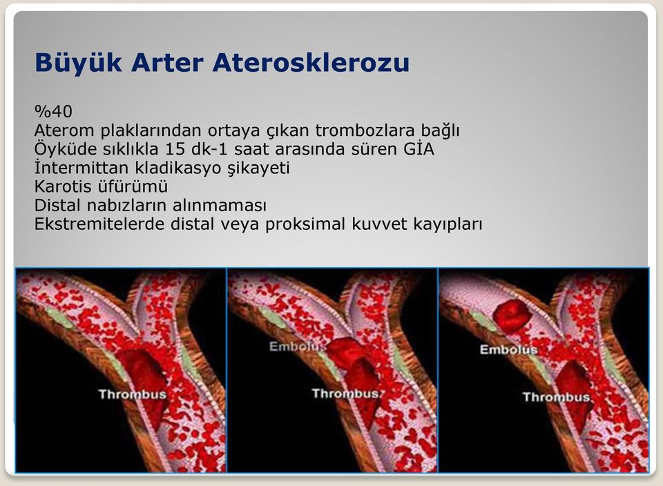 GİA İntermittan kladikasyo şikayeti Karotis üfürümü Distal