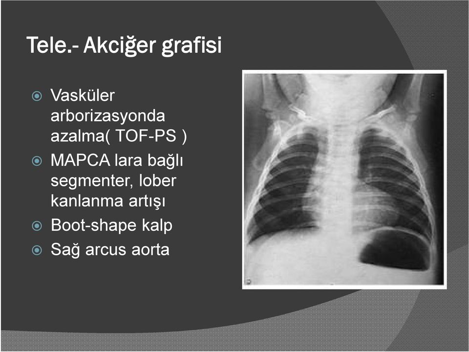 MAPCA lara bağlı segmenter, lober