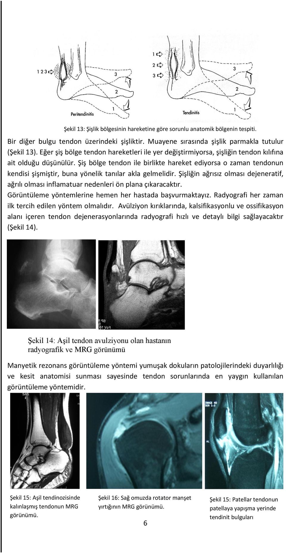 Şiş bölge tendon ile birlikte hareket ediyorsa o zaman tendonun kendisi şişmiştir, buna yönelik tanılar akla gelmelidir.