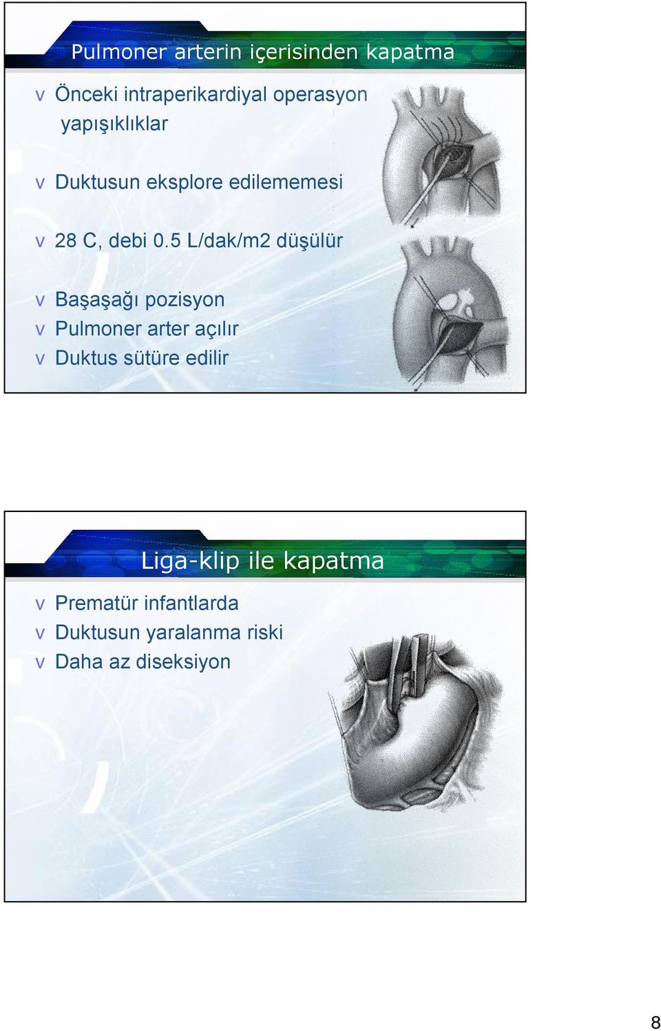 5 L/dak/m2 düşülür vbaşaşağı pozisyon vpulmoner arter açılır vduktus sütüre