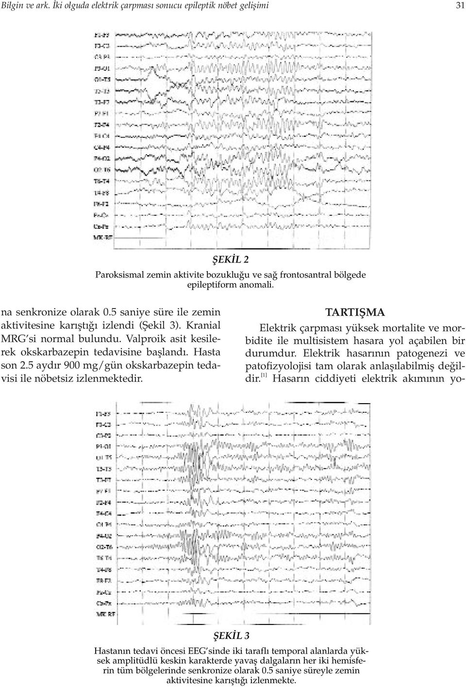 [1] Hasar n ciddiyeti elektrik ak m n n yofiek L 2 Paroksismal zemin aktivite bozuklu u ve sa frontosantral bölgede epileptiform anomali. na senkronize olarak 0.