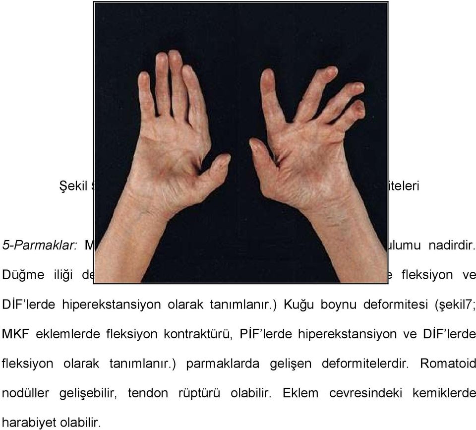 ) Kuğu boynu deformitesi (şekil7; MKF eklemlerde fleksiyon kontraktürü, PİF lerde hiperekstansiyon ve DİF lerde fleksiyon olarak
